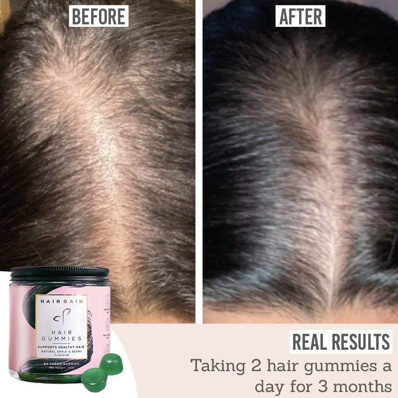 Hair Gain Hair Gummies before and after real results