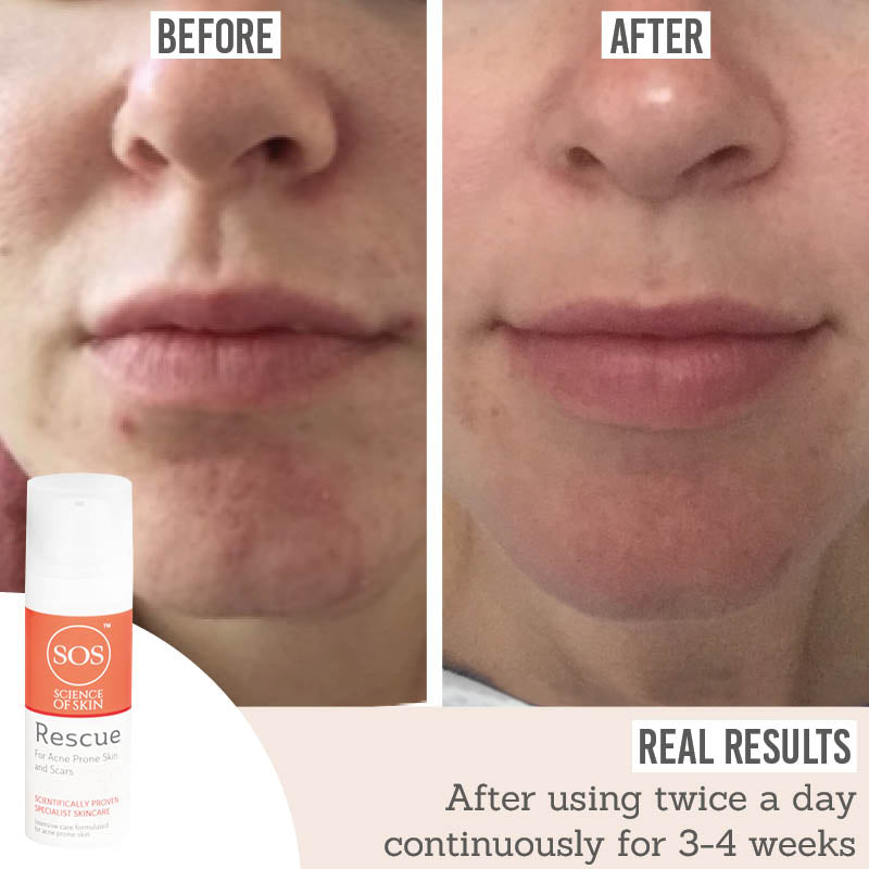 Science of Skincare Rescue before and after results