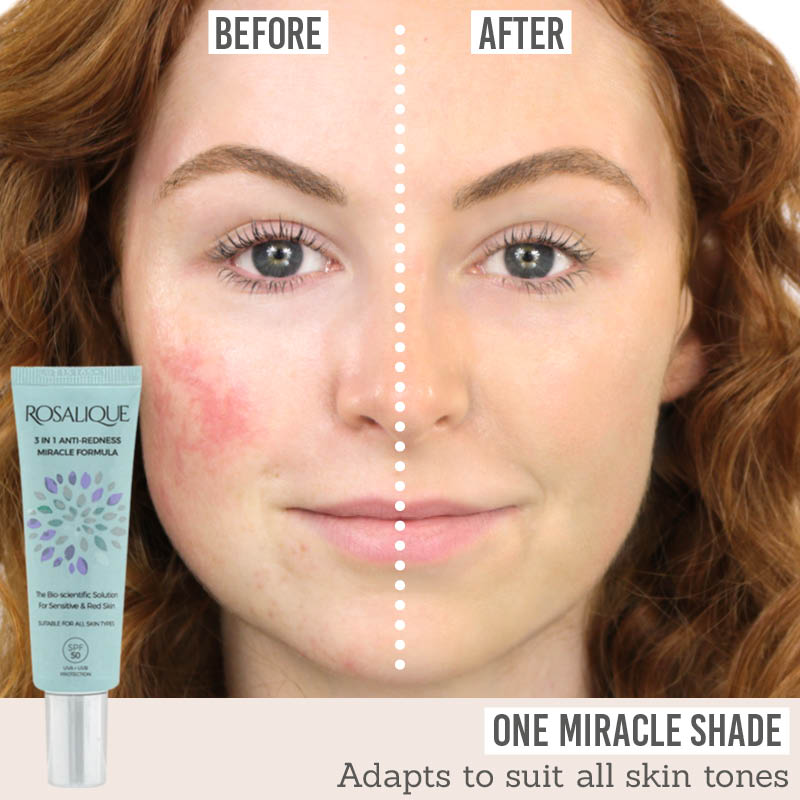 Rosalique 3 in 1 Anti Redness Miracle Formula before and after results